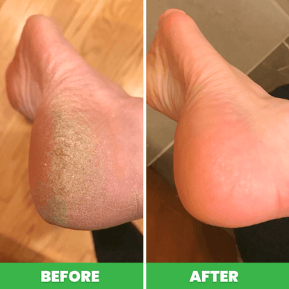 PediPro™ Ultimate Foot Callus Remover